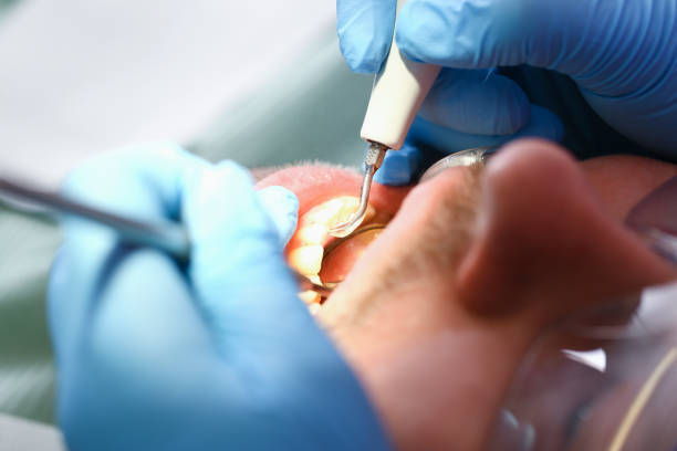 Best Emergency Dental Care for Broken or Chipped Teeth in Woodacre, CA