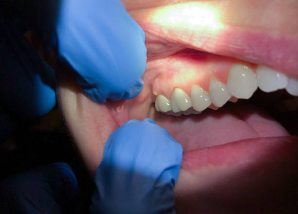 Best Emergency Wisdom Teeth Removal in Woodacre, CA