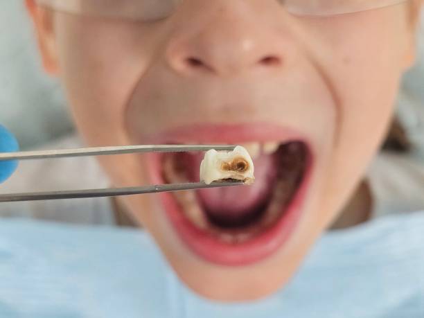 Best Pediatric Emergency Dentist in Woodacre, CA